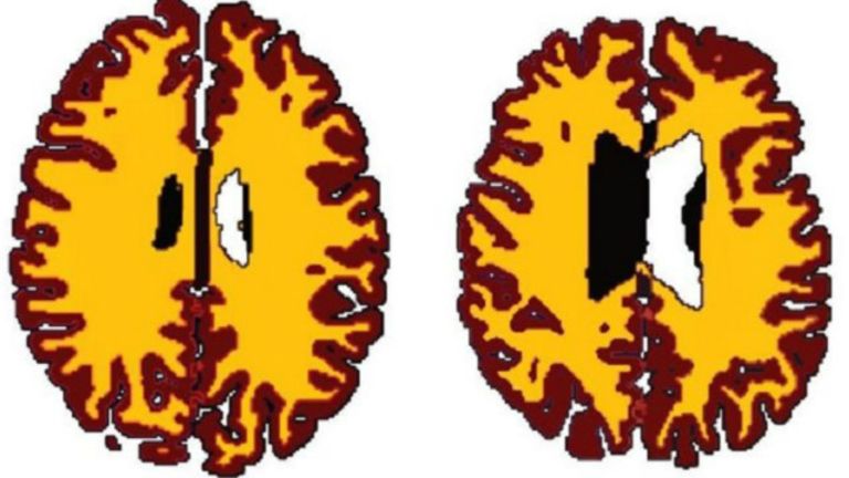 تقل المادة البيضاء مع تقدم السن